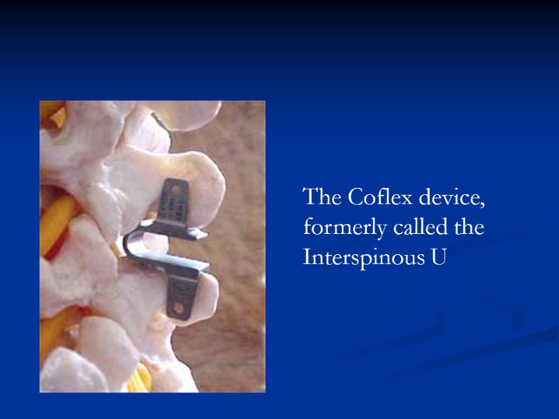 The Coflex device, formerly called the Interspinous U